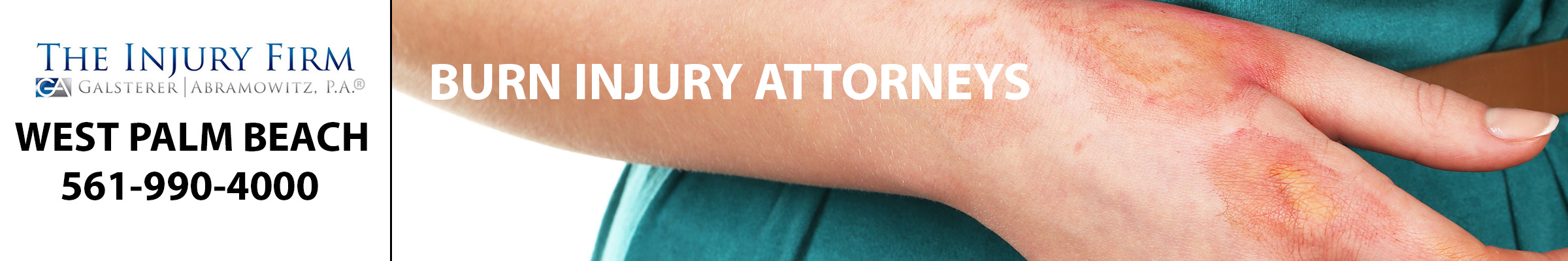 Example of a burn on a person's hand.