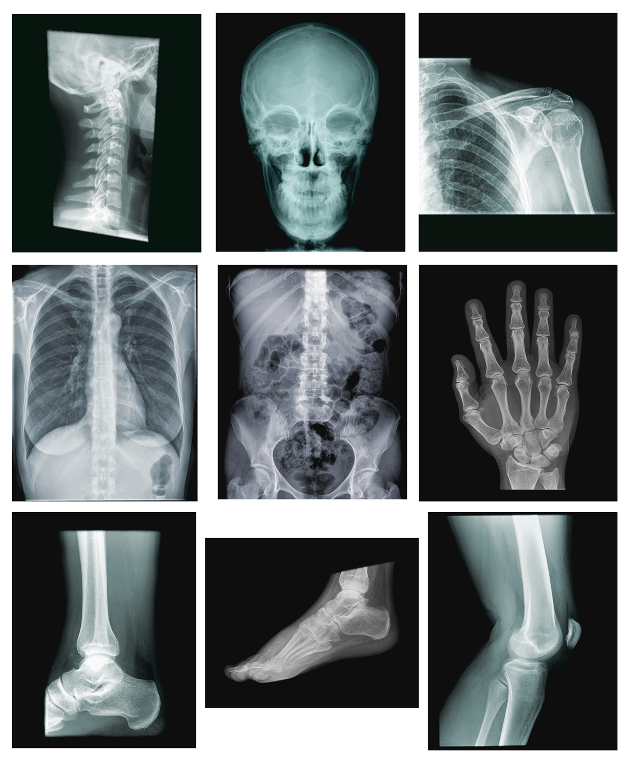 x ray collection slip and fall accident injuries