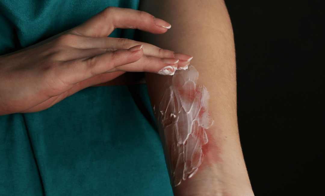 burn injury lawyer west palm beach 1