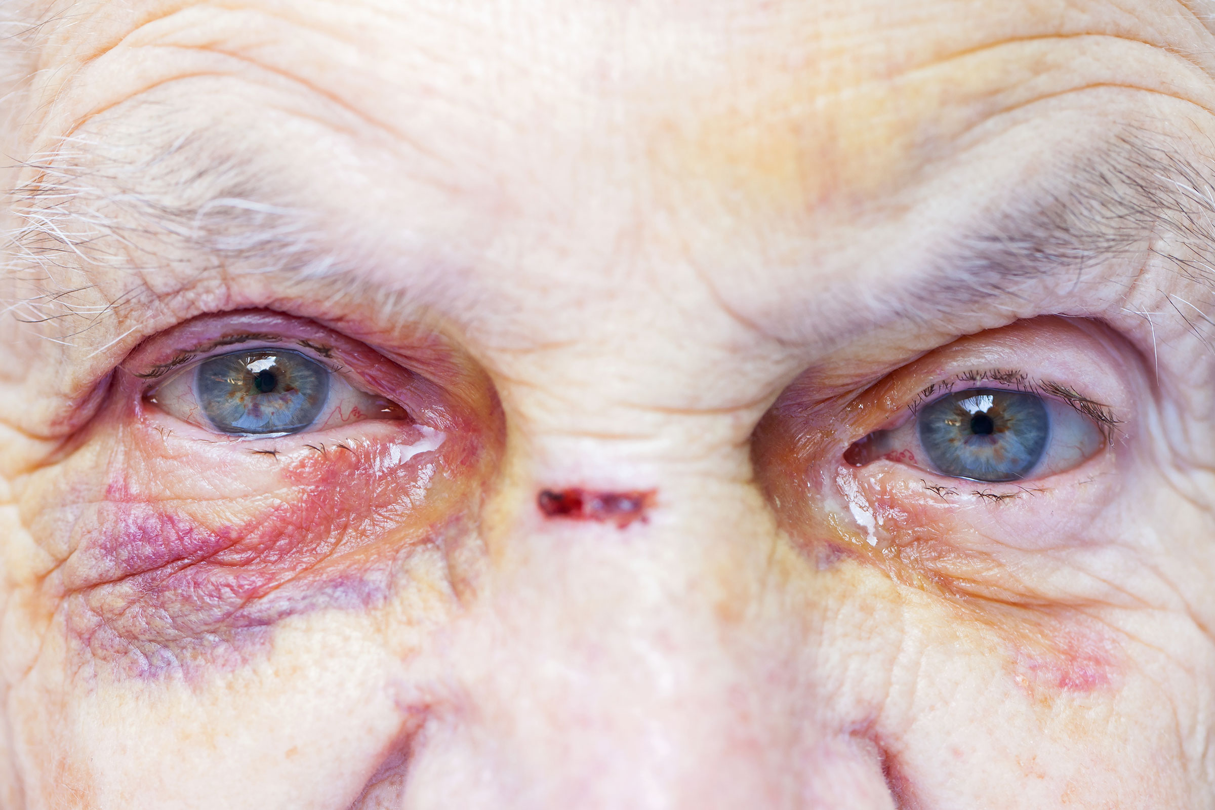 west palm beach nursing home abuse lawyer