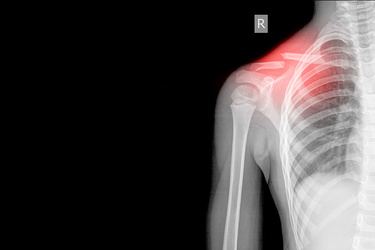 xray right shoulder broken after car accident