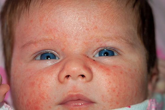 Newborn Baby Girl With Severe Rash Resulting From Shots at Birth