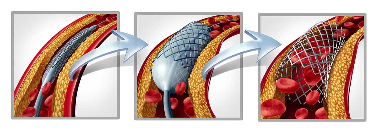 Stent And Angioplasty graphics