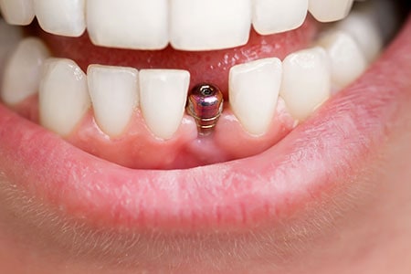 Close up of dental implant prior to adding tooth